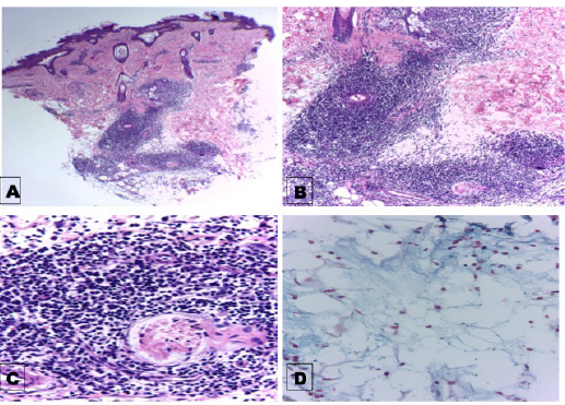 Lupus Erythematosus Tumidus In Childhood Treated With Antimalarials