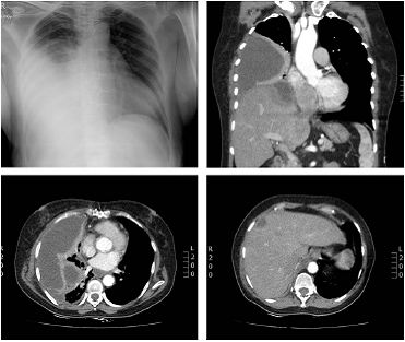 tomografia pulmonar con contraste