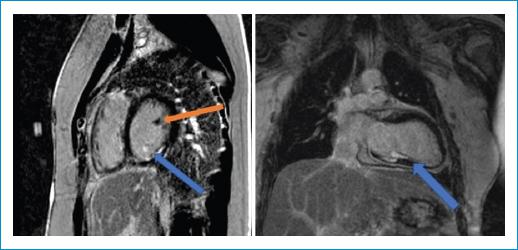 Infarto De Miocardio Con Arterias Coronarias No Obstruidas En Pediatría ...