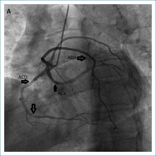 Intervencionismo coronario percutáneo en paciente con anomalía coronaria