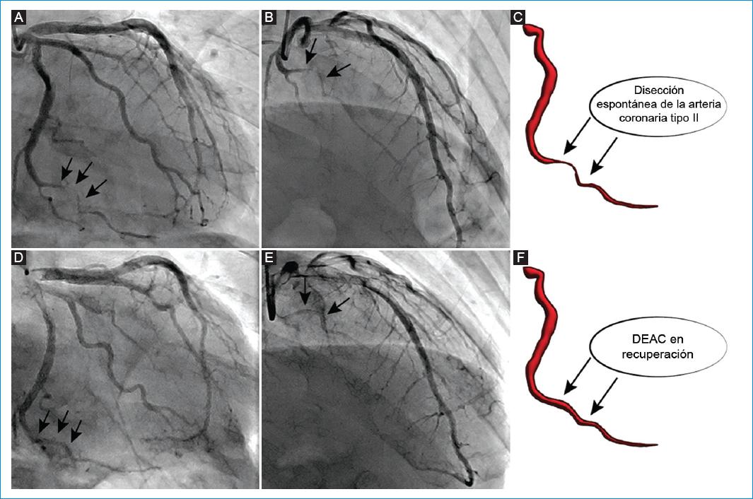 Una estrategia sin stent en síndrome coronario agudo sin aterosclerosis