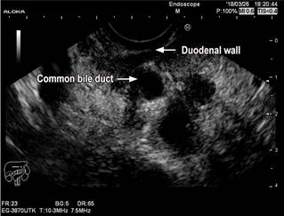 Groove Pancreatitis Mimicking Pancreatic Cancer: Case Report And 