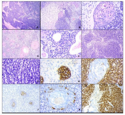 Aggressive Undifferentiated Carcinoma In The Vagina Telegraph