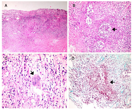 Hypertrophic Pachymeningitis In A Patient With Anca Negative 