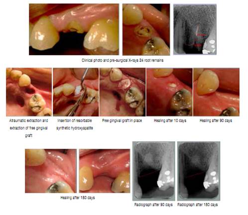 DIMENSIONAL CHANGES OF HARD AND SOFT TISSUES IN POST EXTRACTION