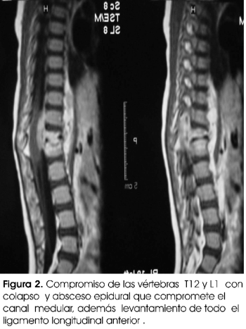Tuberculosis Osteoarticular Primaria Reaparici n De Una Patolog a Olvidada